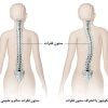 علائم انحراف ستون فقرات کودکان