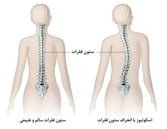 علائم انحراف ستون فقرات کودکان